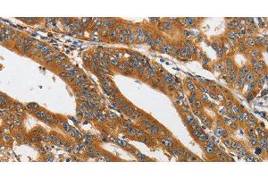 Immunohistochemistry of paraffin-embedded Human gastric cancer tissue using PI 3 Kinase Class 3 Polyclonal Antibody at dilution 1:40 (PIK3C3 Antikörper)