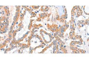 Immunohistochemistry of paraffin-embedded Human thyroid cancer tissue using ACSBG1 Polyclonal Antibody at dilution 1:40 (ACSBG1 Antikörper)