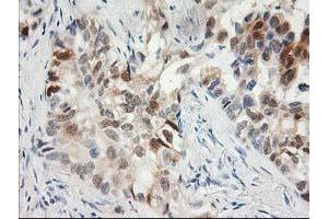 Immunohistochemical staining of paraffin-embedded Carcinoma of Human lung tissue using anti-HPGD mouse monoclonal antibody. (HPGD Antikörper)