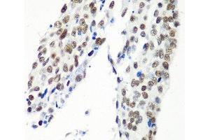 Immunohistochemistry of paraffin-embedded Human lung cancer using HTATSF1 Polyclonal Antibody at dilution of 1:100 (40x lens). (HTATSF1 Antikörper)