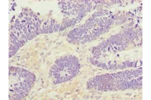 Immunohistochemistry of paraffin-embedded human ovarian cancer using ABIN7166396 at dilution of 1:100 (PADI3 Antikörper  (AA 1-664))