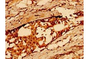 Immunohistochemistry of paraffin-embedded human breast cancer using ABIN7163584 at dilution of 1:100 (CD36 Antikörper  (AA 191-376))