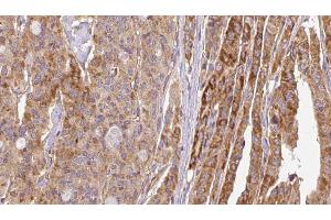 ABIN6267116 at 1/100 staining Human thyroid cancer tissue by IHC-P. (FLT3 Antikörper  (pTyr969))