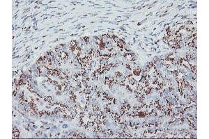 Immunohistochemical staining of paraffin-embedded Adenocarcinoma of Human ovary tissue using anti-GOLM1 mouse monoclonal antibody. (GOLM1 Antikörper)