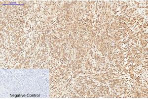 Immunohistochemical analysis of paraffin-embedded human breast cancer tissue. (XRCC4 Antikörper)