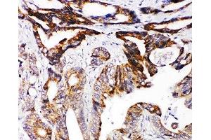 IHC-P: DCC antibody testing of human intestinal cancer tissue (DCC Antikörper  (AA 162-178))