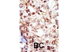 Formalin-fixed and paraffin-embedded human cancer tissue reacted with FGR polyclonal antibody  , which was peroxidase-conjugated to the secondary antibody, followed by AEC staining. (Fgr Antikörper  (N-Term))