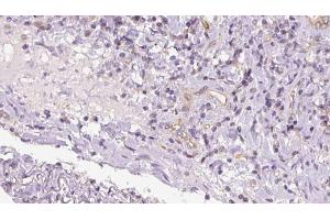 ABIN6273175 at 1/100 staining Human lymph cancer tissue by IHC-P. (TIMM17B Antikörper  (Internal Region))