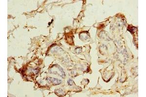 Immunohistochemistry of paraffin-embedded human breast cancer using ABIN7159277 at dilution of 1:100 (MAGEA9 Antikörper  (AA 1-315))