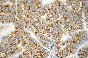 Immunohistochemistry was performed on paraffin-embedded human endometrial carcinoma using vimentin antibody (ABIN7800839), 1:200).