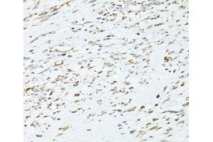 Immunohistochemistry of paraffin-embedded Human uterine cancer using TRIM15 Polyclonal Antibody at dilution of 1:100 (40x lens). (TRIM15 Antikörper)