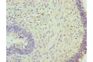 Immunohistochemistry of paraffin-embedded human ovarian cancer using ABIN7160269 at dilution of 1:100 (RNGTT Antikörper  (AA 1-260))