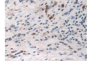 Detection of TNFa in Human Stomach cancer Tissue using Polyclonal Antibody to Tumor Necrosis Factor Alpha (TNFa) (TNF alpha Antikörper  (AA 77-233))