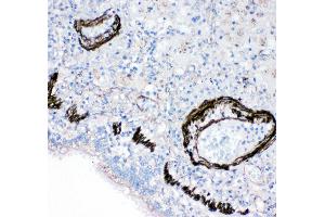 Anti-FABP6 antibody, IHC(P) IHC(P): Human Lung Cancer Tissue (FABP6 Antikörper  (N-Term))