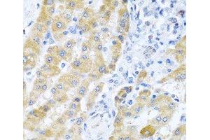Immunohistochemistry of paraffin-embedded Human liver cancer using Gm13125 Polyclonal Antibody at dilution of 1:100 (40x lens). (Pramel15 Antikörper)