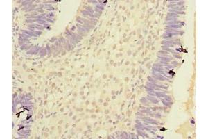 Immunohistochemistry of paraffin-embedded human ovarian cancer using ABIN7146760 at dilution of 1:100 (Carboxypeptidase A2 Antikörper  (AA 115-419))