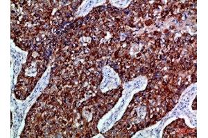 Immunohistochemical analysis of paraffin-embedded Human-lung-cancer, antibody was diluted at 1:100 (EPH Receptor B3 Antikörper  (AA 650-700))