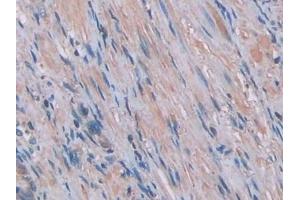 Detection of IL1a in Human Prostate Tissue using Monoclonal Antibody to Interleukin 1 Alpha (IL1a) (IL1A Antikörper  (AA 113-271))