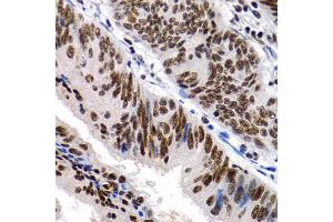 Immunohistochemistry of paraffin-embedded human colon cancer using MT2A antibody (ABIN1873764) at dilution of 1:200 (40x lens). (MT2A Antikörper)