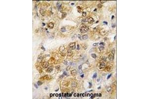 Formalin-fixed and paraffin-embedded human prostata carcinoma tissue reacted with HS antibody (ABIN388133 and ABIN2846370) , which was peroxidase-conjugated to the secondary antibody, followed by DAB staining.