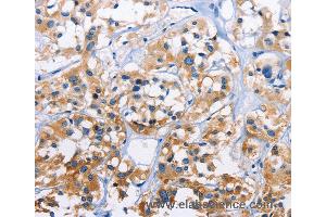 Immunohistochemistry of Human thyroid cancer using CAPZA3 Polyclonal Antibody at dilution of 1:70 (CAPZA3 Antikörper)