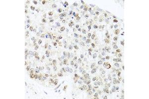 Immunohistochemistry of paraffin-embedded human lung cancer using CETN3 antibody at dilution of 1:100 (x40 lens). (CETN3 Antikörper)