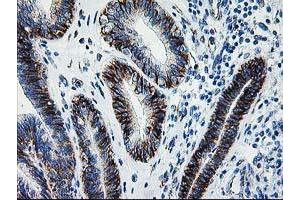 Immunohistochemical staining of paraffin-embedded Adenocarcinoma of Human endometrium tissue using anti-SOCS3 mouse monoclonal antibody. (SOCS3 Antikörper)