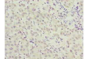 Immunohistochemistry of paraffin-embedded human liver cancer using ABIN7167643 at dilution of 1:100 (RENT2/UPF2 Antikörper  (AA 1153-1272))