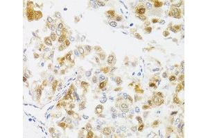 Immunohistochemistry of paraffin-embedded Human liver cancer using MYO5A Polyclonal Antibody at dilution of 1:100 (40x lens). (MYO5A Antikörper)