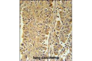 PGD Antibody immunohistochemistry analysis in formalin fixed and paraffin embedded human lung carcinoma followed by peroxidase conjugation of the secondary antibody and DAB staining.