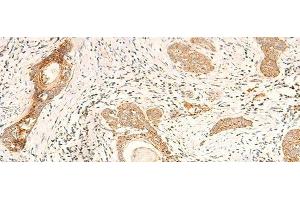Immunohistochemistry of paraffin-embedded Human esophagus cancer tissue using MT-CO2 Polyclonal Antibody at dilution of 1:60(x200)