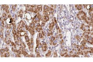 ABIN6278511 at 1/100 staining Human liver cancer tissue by IHC-P.