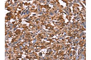 The image on the left is immunohistochemistry of paraffin-embedded Human thyroid cancer tissue using ABIN7191000(HRASLS2 Antibody) at dilution 1/40, on the right is treated with synthetic peptide. (HRASLS2 Antikörper)
