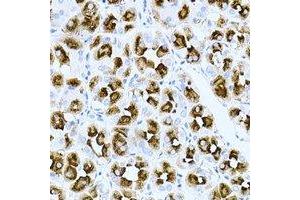 Immunohistochemical analysis of Rac 1 staining in human gastric cancer formalin fixed paraffin embedded tissue section. (RAC1 Antikörper)