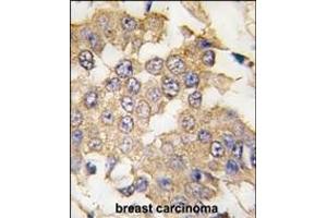 Formalin-fixed and paraffin-embedded human breast carcinoma tissue reacted with ERK2 antibody (C-term) (ABIN391720 and ABIN2841610) , which was peroxidase-conjugated to the secondary antibody, followed by DAB staining. (ERK2 Antikörper  (C-Term))