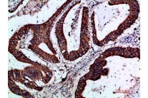 Immunohistochemical analysis of paraffin-embedded human-colon-cancer, antibody was diluted at 1:200. (GREM2 Antikörper  (AA 71-120))