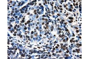 Immunohistochemical staining of paraffin-embedded Adenocarcinoma of breast tissue using anti-PSMC3 mouse monoclonal antibody. (PSMC3 Antikörper)