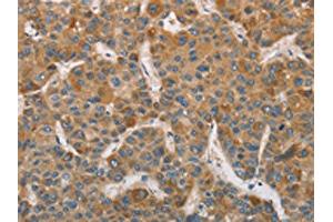 The image on the left is immunohistochemistry of paraffin-embedded Human liver cancer tissue using ABIN7129185(DDX53 Antibody) at dilution 1/75, on the right is treated with fusion protein. (DDX53 Antikörper)