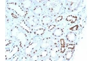 IHC testing of FFPE human renal cell carcinoma with PAX8 antibody (clone PAX8/1492). (PAX8 Antikörper  (AA 60-261))