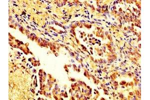 IHC image of ABIN7160125 diluted at 1:200 and staining in paraffin-embedded human lung cancer performed on a Leica BondTM system. (Moesin Antikörper  (AA 466-572))