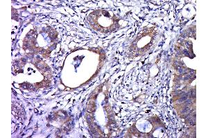 Paraformaldehyde-fixed, paraffin embedded human cervical cancer, Antigen retrieval by boiling in sodium citrate buffer (pH6. (Human Papilloma Virus 16 E6 (HPV-16 E6) (AA 85-158) Antikörper)