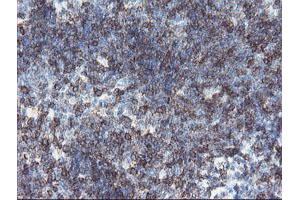 Immunohistochemical staining of paraffin-embedded Human lymphoma tissue using anti-DPH2 mouse monoclonal antibody. (DPH2 Antikörper)