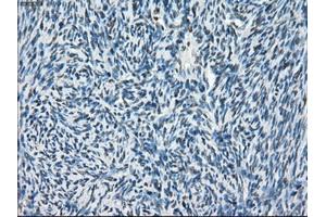 Immunohistochemical staining of paraffin-embedded Adenocarcinoma of breast tissue using anti-POR mouse monoclonal antibody. (POR Antikörper)