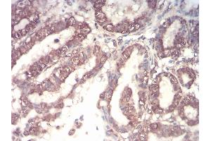 Immunohistochemical analysis of paraffin-embedded esophageal cancer tissues using CSF3 mouse mAb with DAB staining. (G-CSF Antikörper  (AA 1-207))