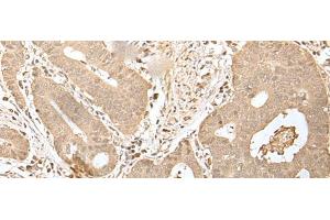 Immunohistochemistry of paraffin-embedded Human gastric cancer tissue using HDHD2 Polyclonal Antibody at dilution of 1:40(x200)