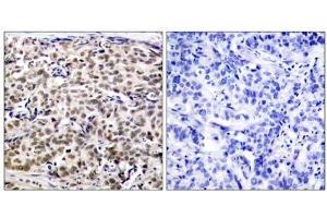 Immunohistochemical analysis of paraffin-embedded human breast carcinoma tissue using CREB (Ab-129) antibody (E021265). (CREB1 Antikörper)