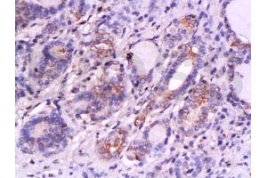 Formalin-fixed and paraffin embedded human thyroid carcinoma labeled with Anti-SKP2/skp2 p45 Polyclonal Antibody, Unconjugated (ABIN737601) at 1:200 followed by conjugation to the secondary antibody and DAB staining. (SKP2 Antikörper  (AA 351-424))