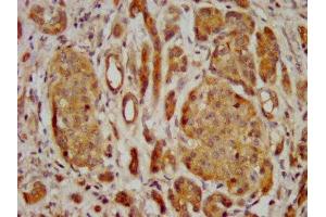 IHC image of ABIN7153155 diluted at 1:400 and staining in paraffin-embedded human pancreatic cancer performed on a Leica BondTM system. (FREM2 Antikörper  (AA 1986-2127))