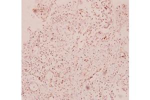 Immunohistochemistry analysis of RANTES Antibody in paraffin-embedded human breast carcinoma tissue at 1/100.