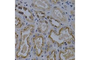 Immunohistochemistry of paraffin-embedded human kidney cancer using TNFRSF6B antibody at dilution of 1:200 (400x lens). (TNFRSF6B Antikörper)